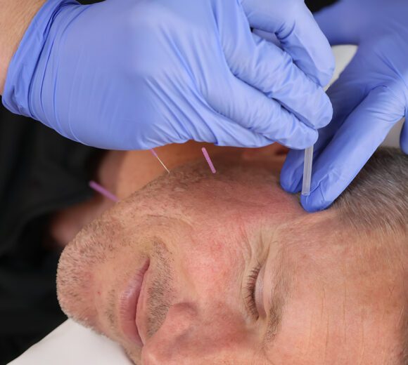 Dry needling on a patient