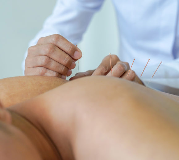 What is dry needling?